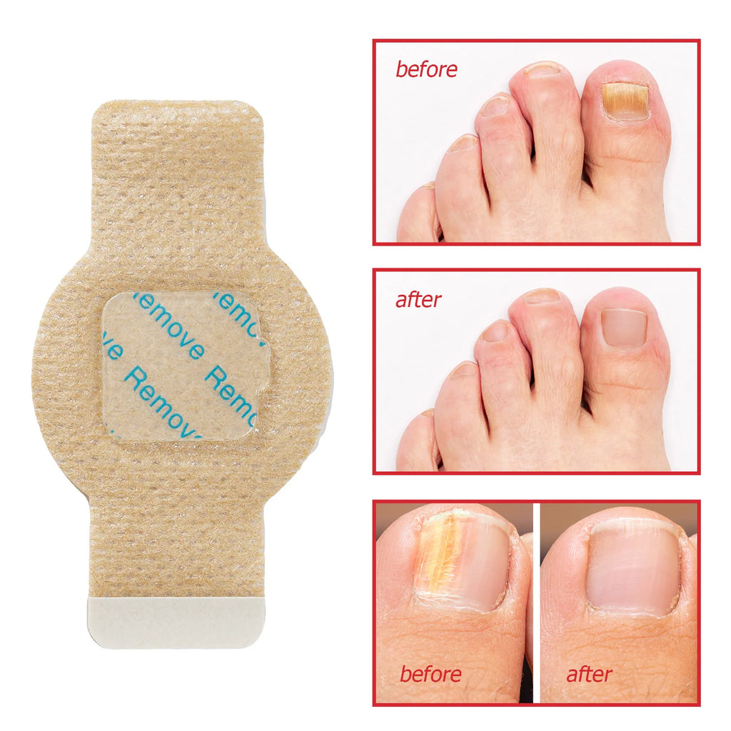Nail Fungus Patches Overnight Adhesive Strips